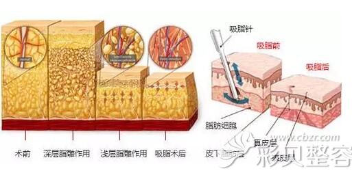 吸脂手术原理