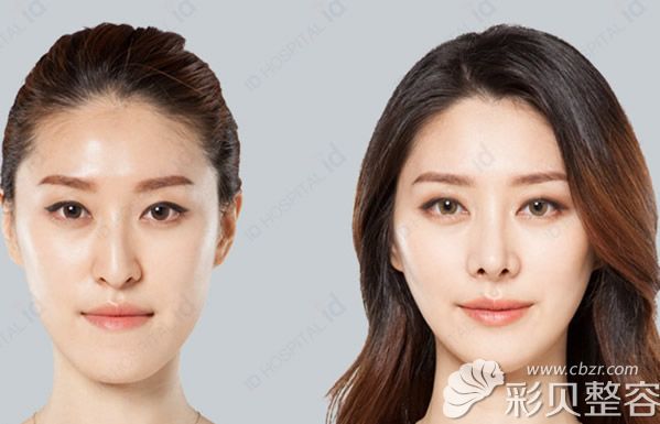 韩国ID医院李知赫做面部轮廓有多好?看过案例效果图秒懂！