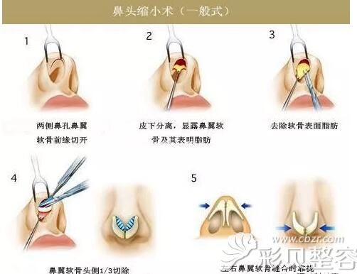 鼻头缩小手术过程图