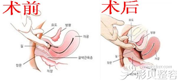 尹虎珠院长做阴道紧缩术前后效果示意图