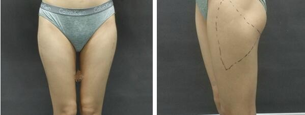 我找北京欧扬胡智鹏医生大腿吸脂1500cc一个月后腿竟细了6cm