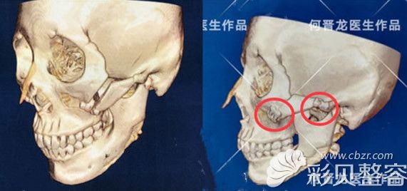 颧骨整形失败修复后拍的CT对比照