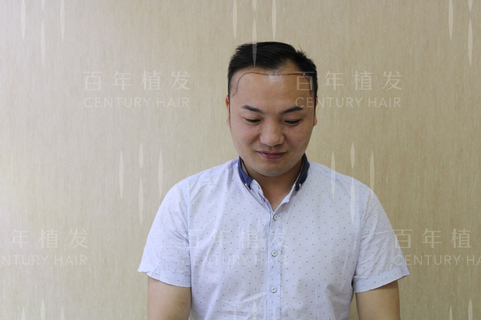 UST-E显微加密种植，显现男性阳刚气质