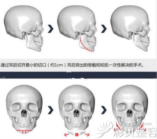 原辰朴钟哲轮廓整形优点