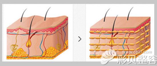 脂肪移植前后对比图
