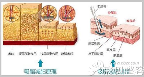 吸脂减肥原理和过程图