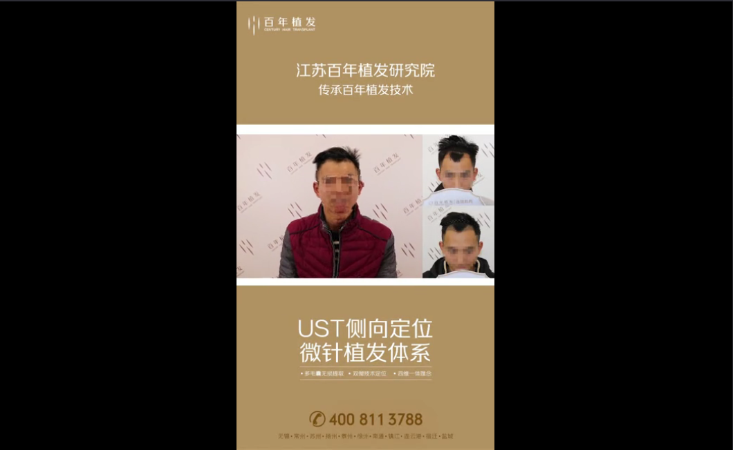 小哥哥额角加密术后第十天，感觉非常好