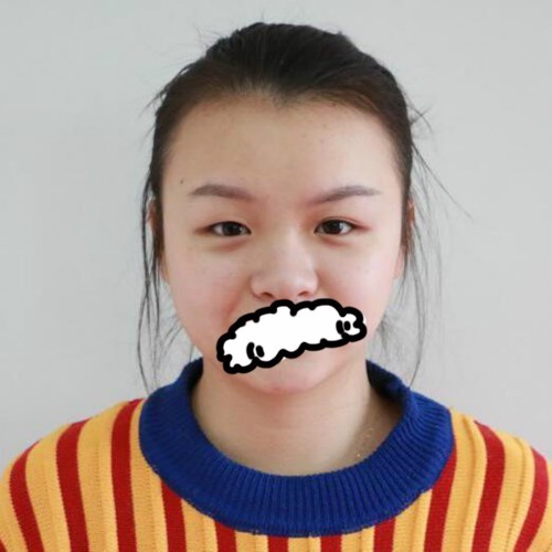 朋友们说我找贵阳华美陈远琨做双眼皮+全鼻整形前后变化大