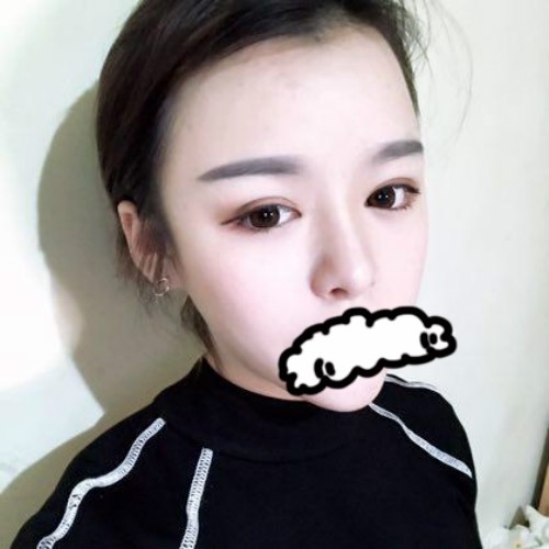 朋友们说我找贵阳华美陈远琨做双眼皮+全鼻整形前后变化大