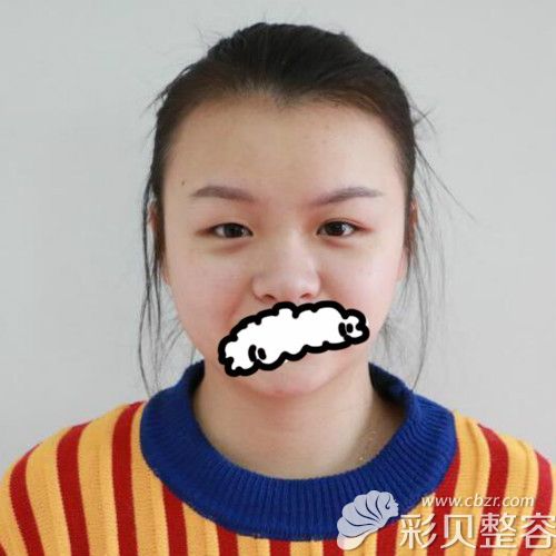 找贵阳华美陈远琨做双眼皮和隆鼻手术前照片