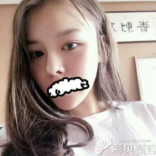 华美陈远琨给我做全切双眼皮+隆鼻术后2个月恢复效果