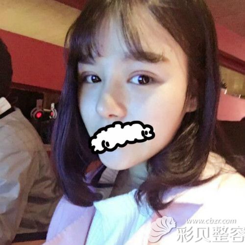 做眼综合+鼻综合术后2个效果