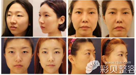 祛眼袋前后对比