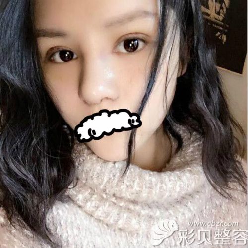 做全切双眼皮和自体肋软骨隆鼻手术拆线后照片