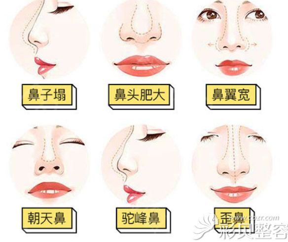 鼻综合隆鼻可以改善哪些鼻形