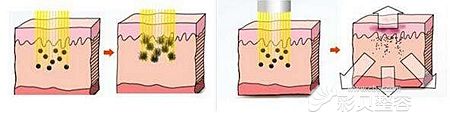 激光祛斑的原理分析
