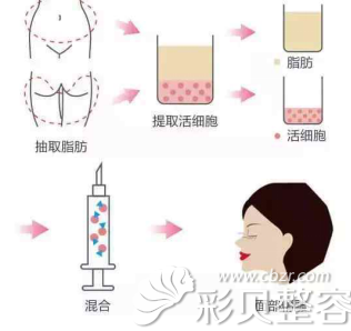 自体脂肪丰苹果肌