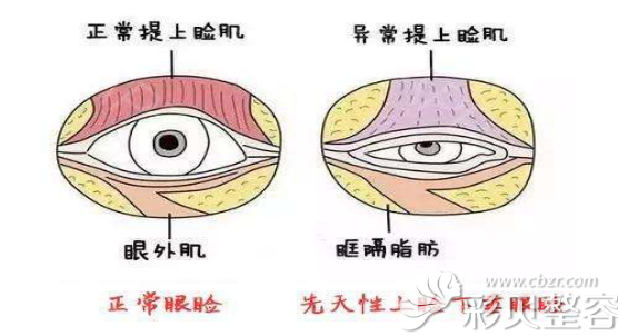 提上睑肌对比图