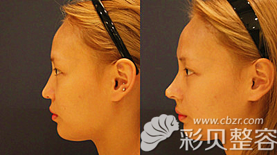 韩国艾恩崔源哲院长术后对比图