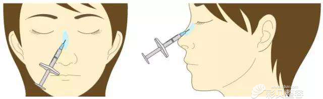 艾恩玻尿酸注射隆鼻