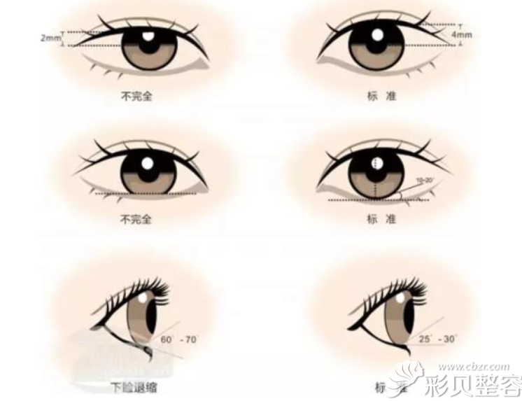 福州海峡陈建忠讲双眼皮术后注意事项有哪些