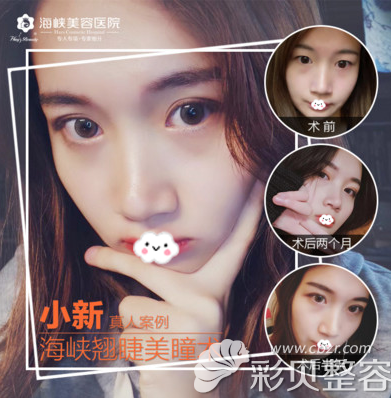 福州海峡双眼皮手术案例