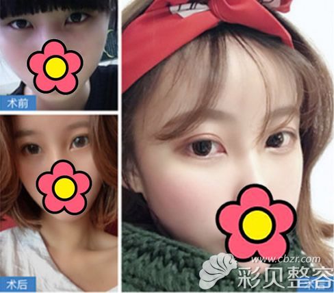 福州美贝尔赵栋材医生做眼睛怎么样