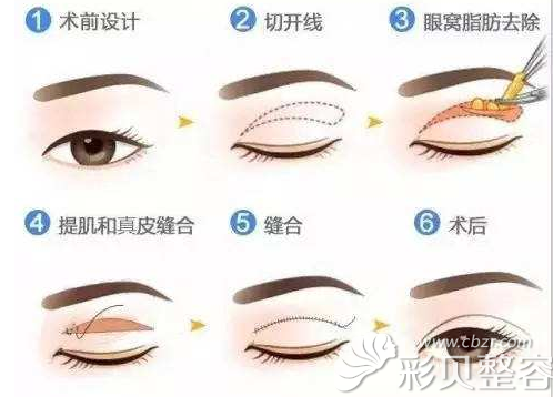 全切双眼皮手术方法