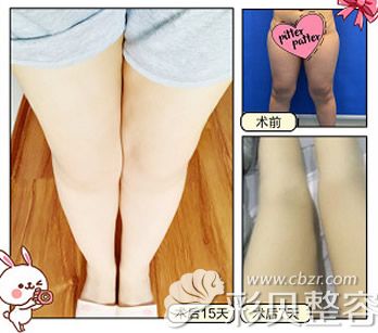 福州美贝尔大腿吸脂前后对比照