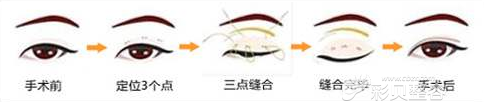 定点双眼皮手术方法