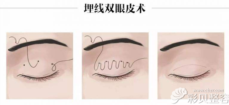埋线双眼皮手术方法