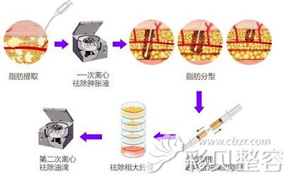 察鹏飞对PRF自体脂肪移植进行解析