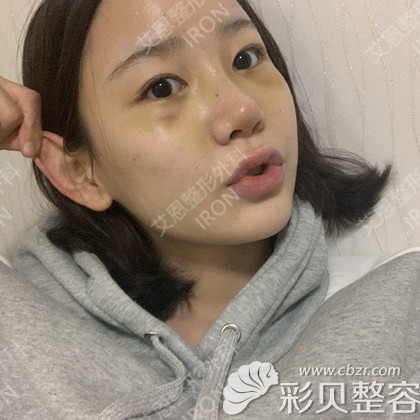 韩国艾恩假体隆鼻真人案例