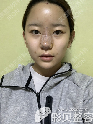 韩国艾恩假体隆鼻术后当天