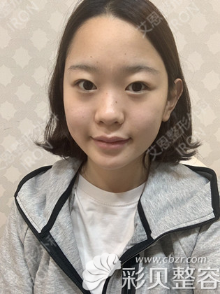 韩国艾恩医硅胶隆鼻术前