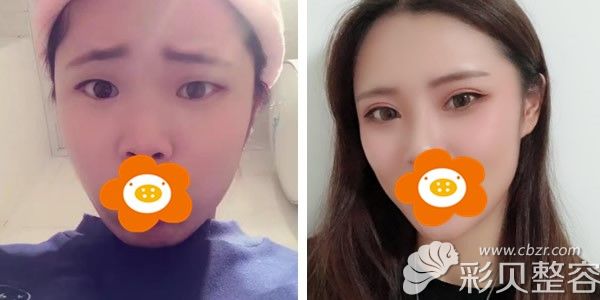 福州海峡整形薛克墘为我选择了一款很适合自己双眼皮形态