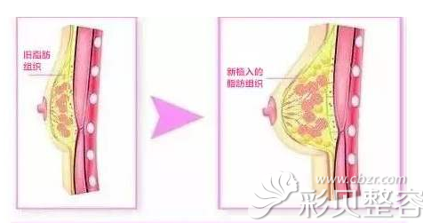 韩国艾恩自体脂肪丰胸胸部注射的位置