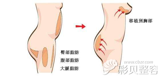 较瘦的妹子让金承俊做自体脂肪丰胸脂肪存活率高吗？