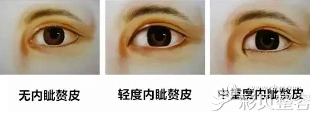 内眦赘皮<span style=