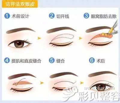 切开双眼皮图解