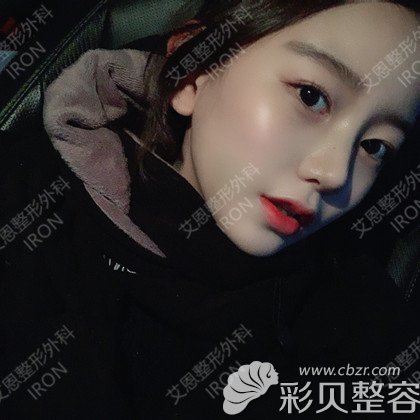 韩国艾恩金尹镐院长假体隆鼻术后自然