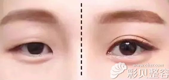 割双眼皮和消除肿泡眼效果对比图