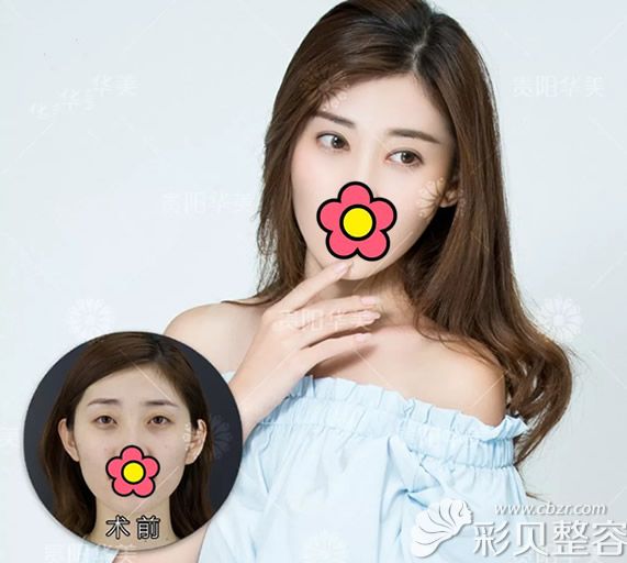 贵阳华美黄在弘全切7.5毫米双眼皮一年后效果