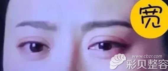 太宽或太窄的双眼皮都不好看