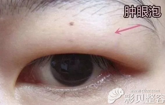 肿泡眼消除后眼睛会变大!来福州海峡做过手术的人都这样说!