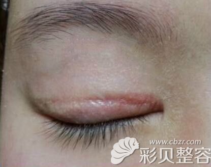 全切双眼皮术后3个月疤痕增生