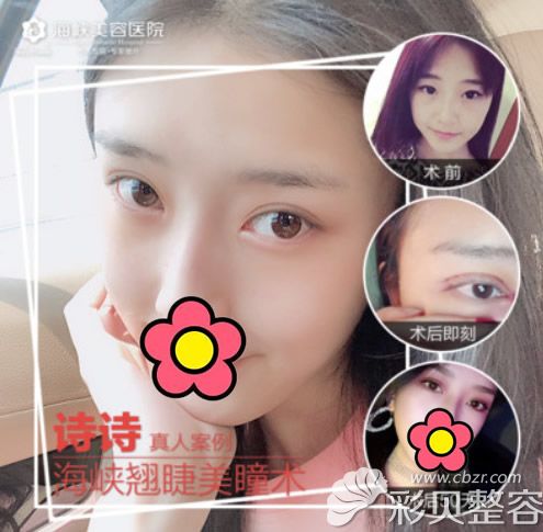 福州海峡眼综合整形案例
