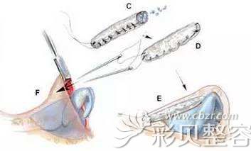 福州海峡薛克墘说做自体肋软骨隆鼻术后缝合仔细