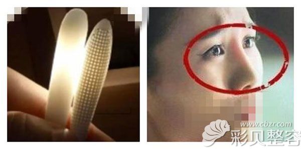 韩国生科三段隆鼻会穿透鼻尖并有透光的现象吗