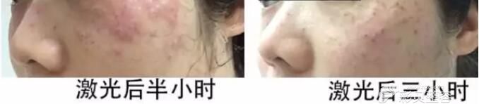 张光泽讲了激光美容术后可能会出现的正常恢复情况